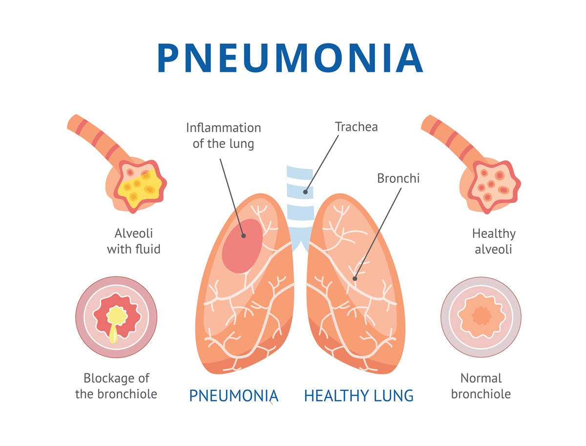 Pneumónia - zápalový proces v tkanive pľúc